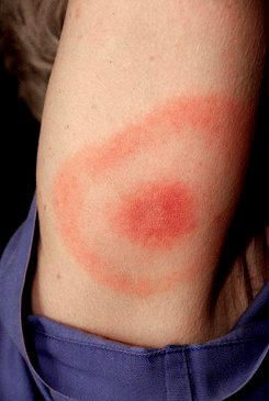 bull's eye rash